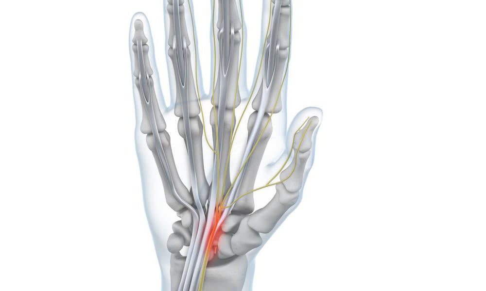 Carpal Tunnel Syndrome (CTS) - Bauerfeind United Kingdom