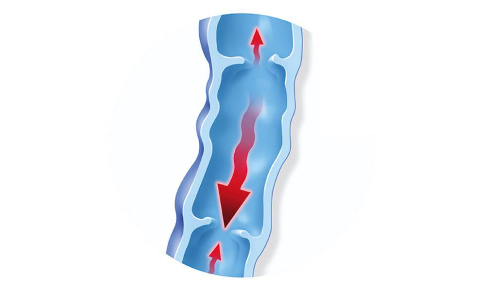 Varicose Veins - Bauerfeind United Kingdom