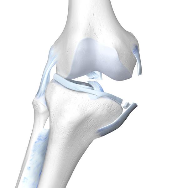 Unhappy Triad - ACL, MCL, & Meniscus Damage - Bauerfeind United Kingdom